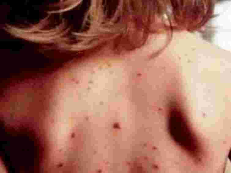 На Прикарпатті - спалах кору в школах