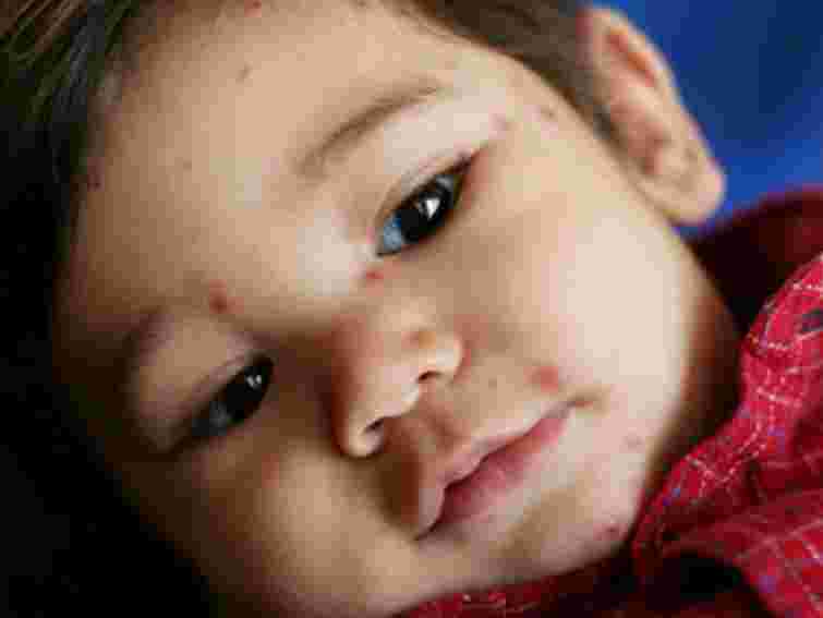 МОЗ: Кір поширюється, але епідемії не буде