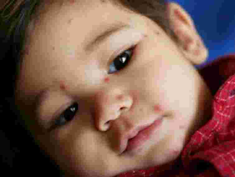 Минулої доби в Україні зафіксовано 33 випадки кору 