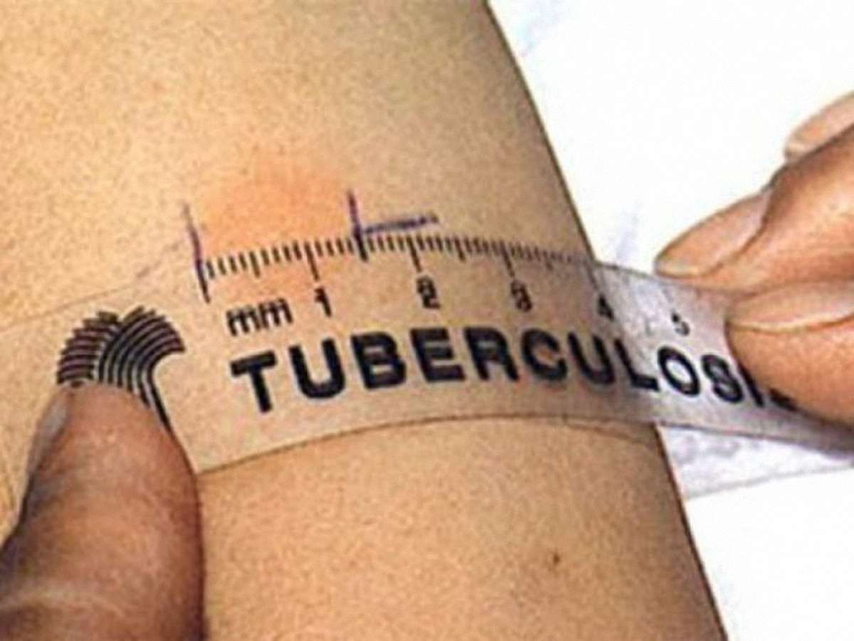 У Львові зменшилася смертність від туберкульозу