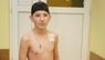12-річному хлопчику у Львові вперше поставили протез «на виріст»