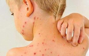 У Львові та області заборонили пускати до шкіл та дитсадків нещеплених від кору дітей