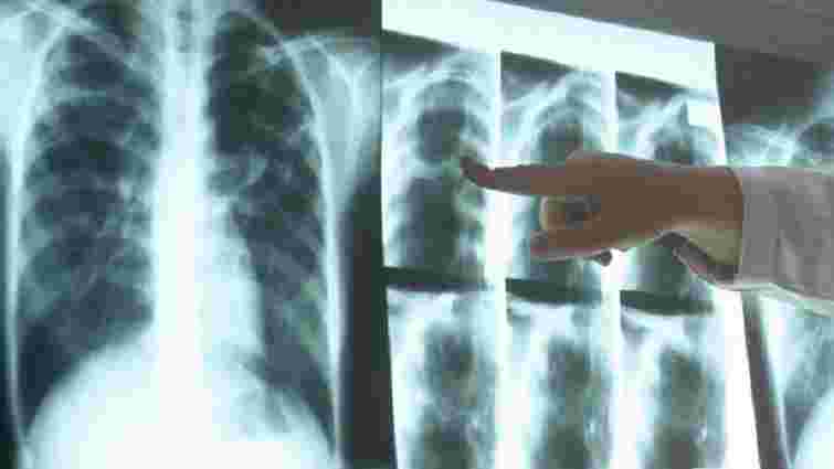 МОЗ запровадить альтернативні методи для ранньої діагностики туберкульозу