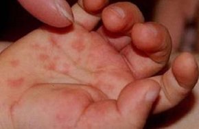 У Львові від кору померла 3-річна нещеплена дитина