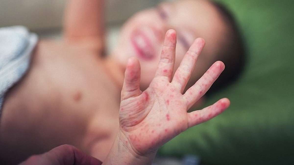У селі на Закарпатті майже одночасно 56 дітей захворіли на кір