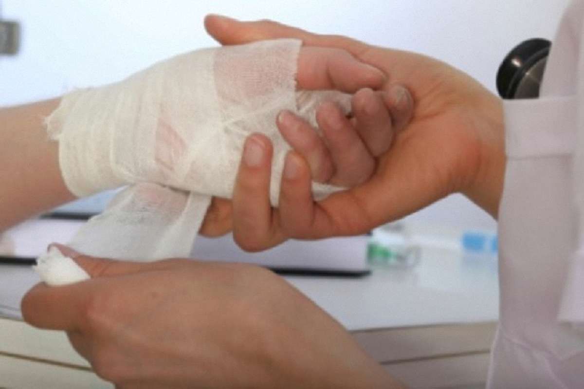Під час господарських робіт мешканець Миколаївського району отримав опіки