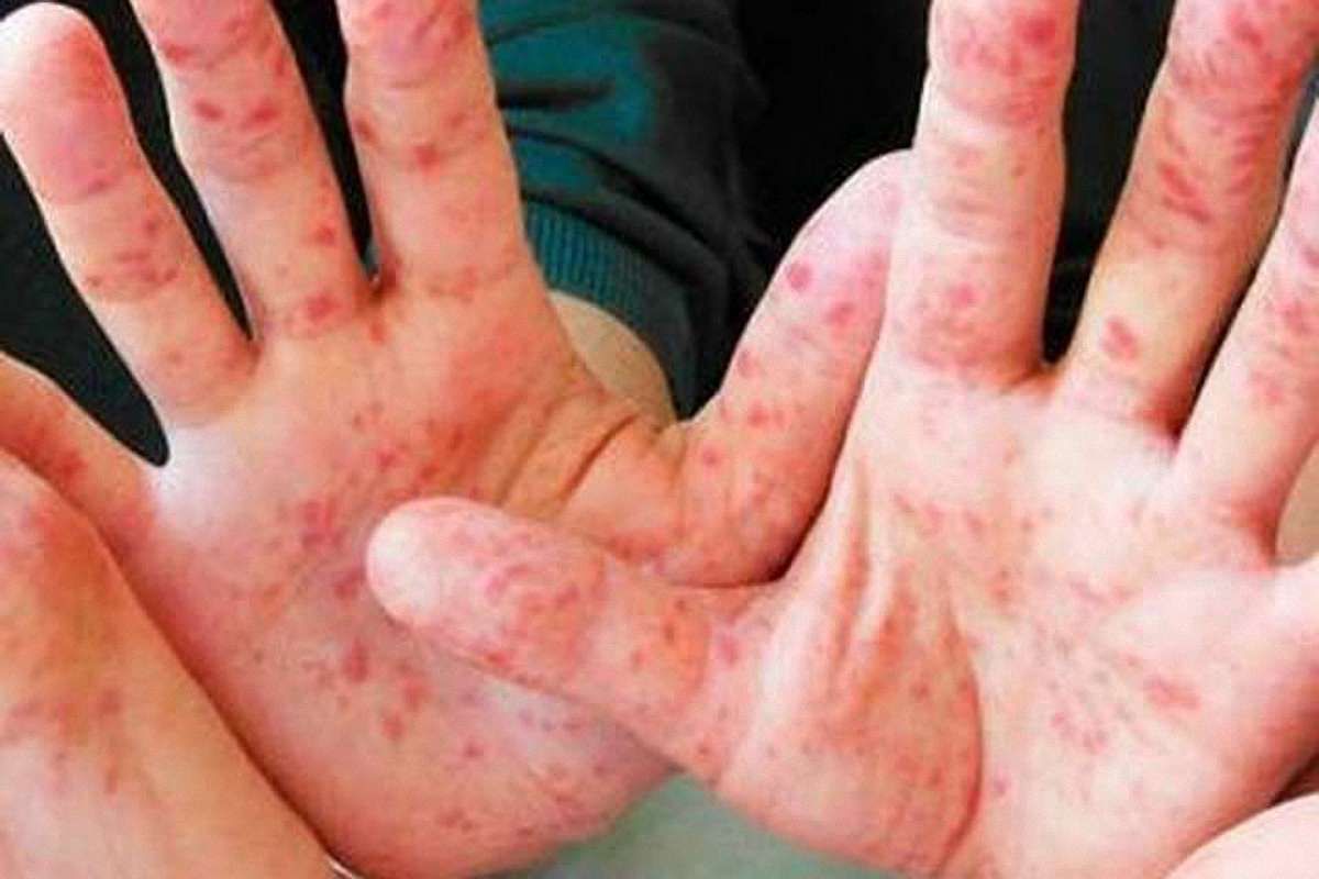 У селі Лапаївка поблизу Львова на кір захворіло 28 школярів