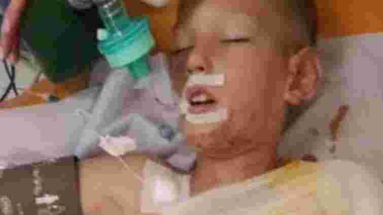 У Дніпрі діти облили бензином і підпалили 8-річного хлопчика, він у реанімації