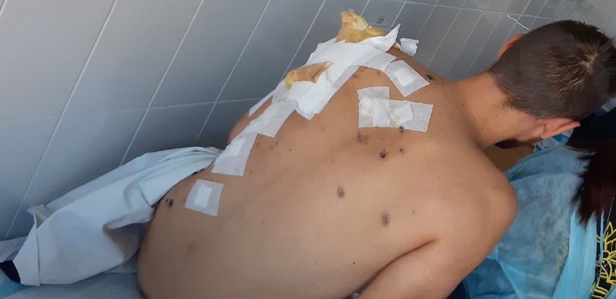 Бойовики на Донбасі почали застосовувати снаряди з різними уражальними елементами
