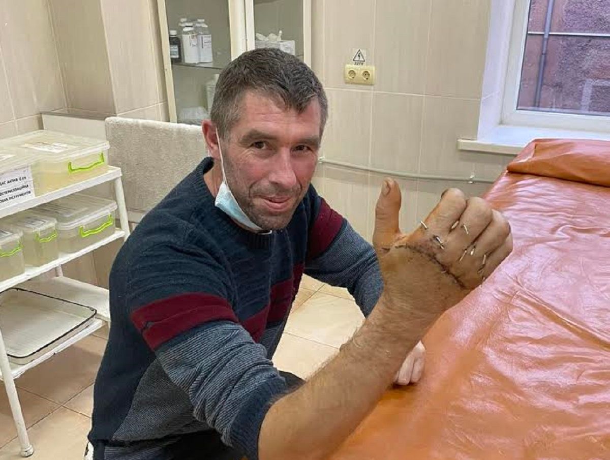Львівські хірурги пришили 39-річному мешканцю Бродівщини відрізану циркуляркою руку