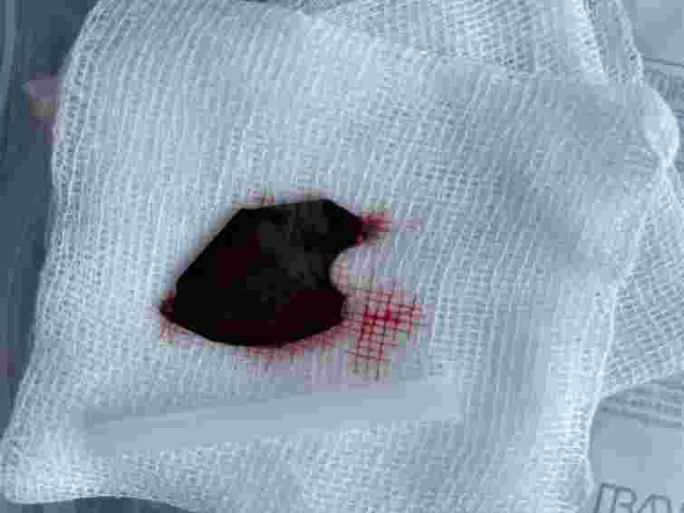 Тернопільські медики врятували 33-річного чоловіка зі шматком пили у шиї Тернопільські медики врятували 33-річного чоловіка зі шматком пили у шиї