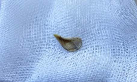 55-річна мешканка Львівщини місяць проходила з кісткою у дихальних шляхах