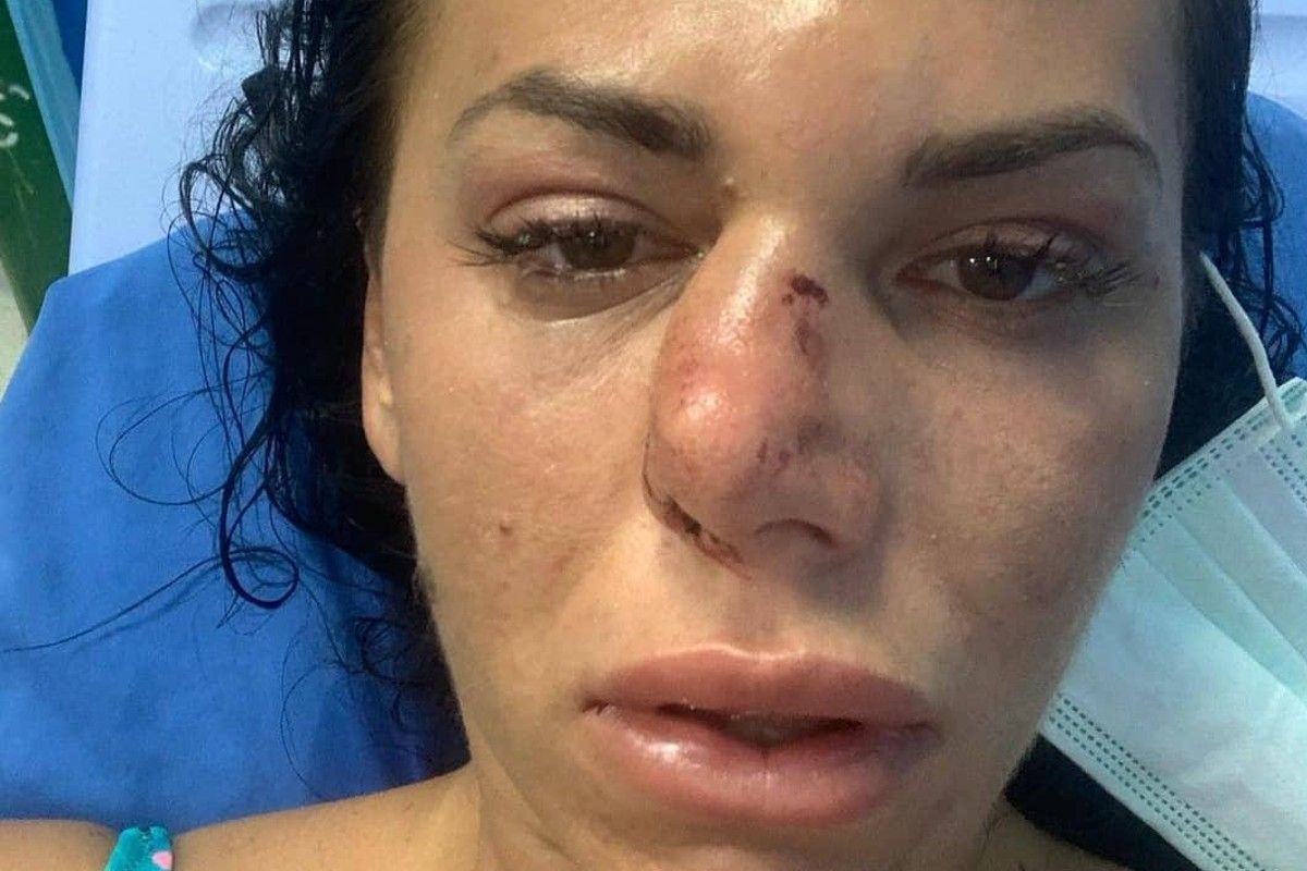 36-річна спортсменка з Тернополя отримала серйозні травми на відпочинку у Таїланді