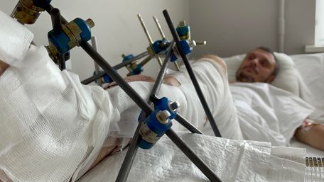 Львівські хірурги врятували 40-річного львів’янина від ампутації ноги