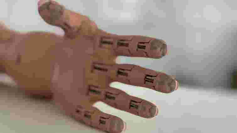 У Львові пацієнту встановили найлегший надрукований на 3D-принтері протез руки