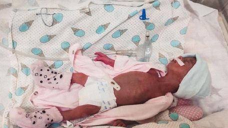 Медики із Рогатина виходили новонароджену дівчинку з вагою 775 грамів
