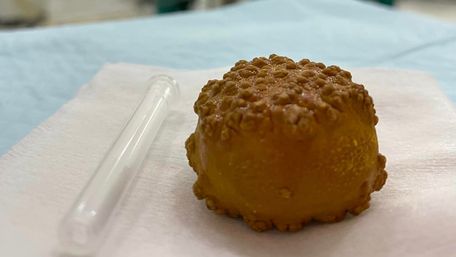 Нововолинські хірурги видалили з сечового міхура пацієнта 5-сантиметровий камінь