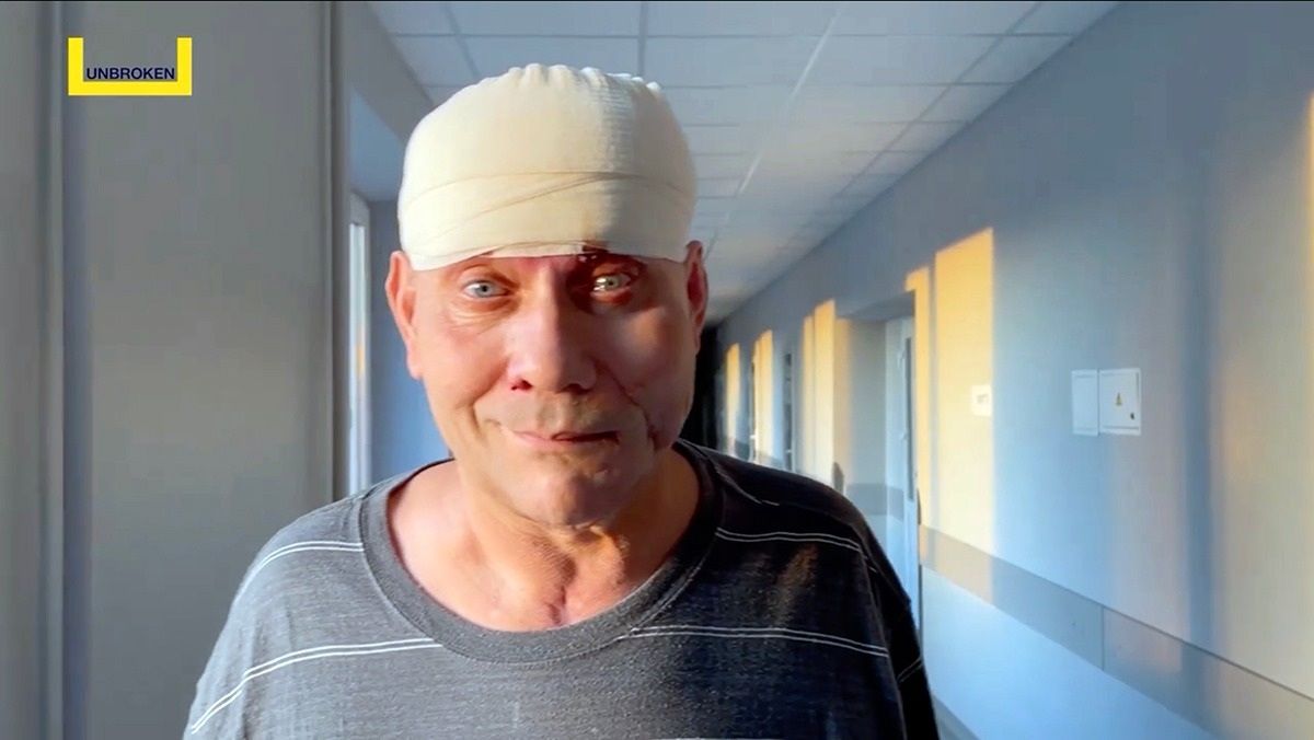 Хірурги пересадили мешканцю Херсонщини м'яз зі спини на голову