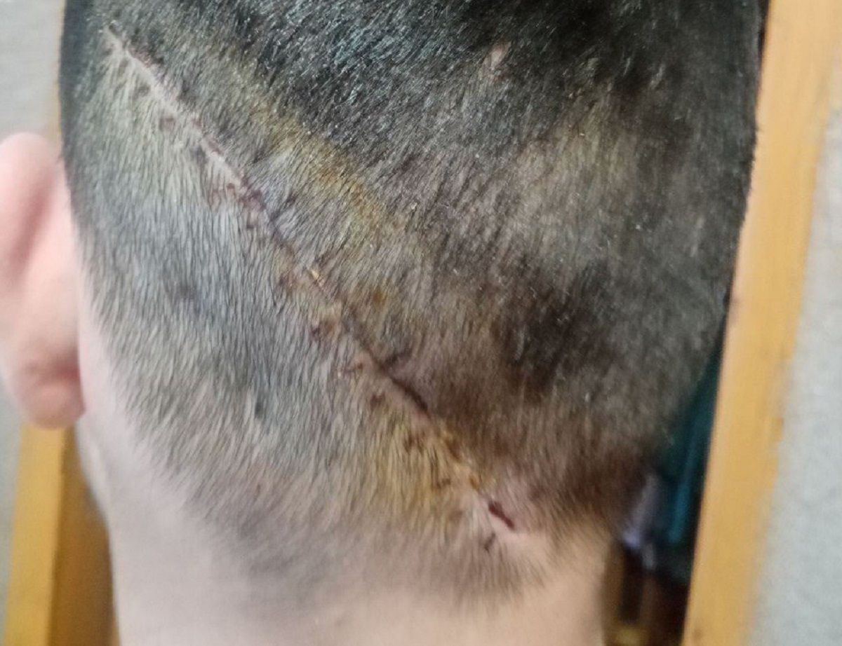 У Рівному прооперували 16-річного хлопця, який травмував голову гойдалкою