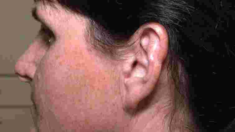 У Рівному пацієнтці пересадили частину вуха, щоб виправити травму носа