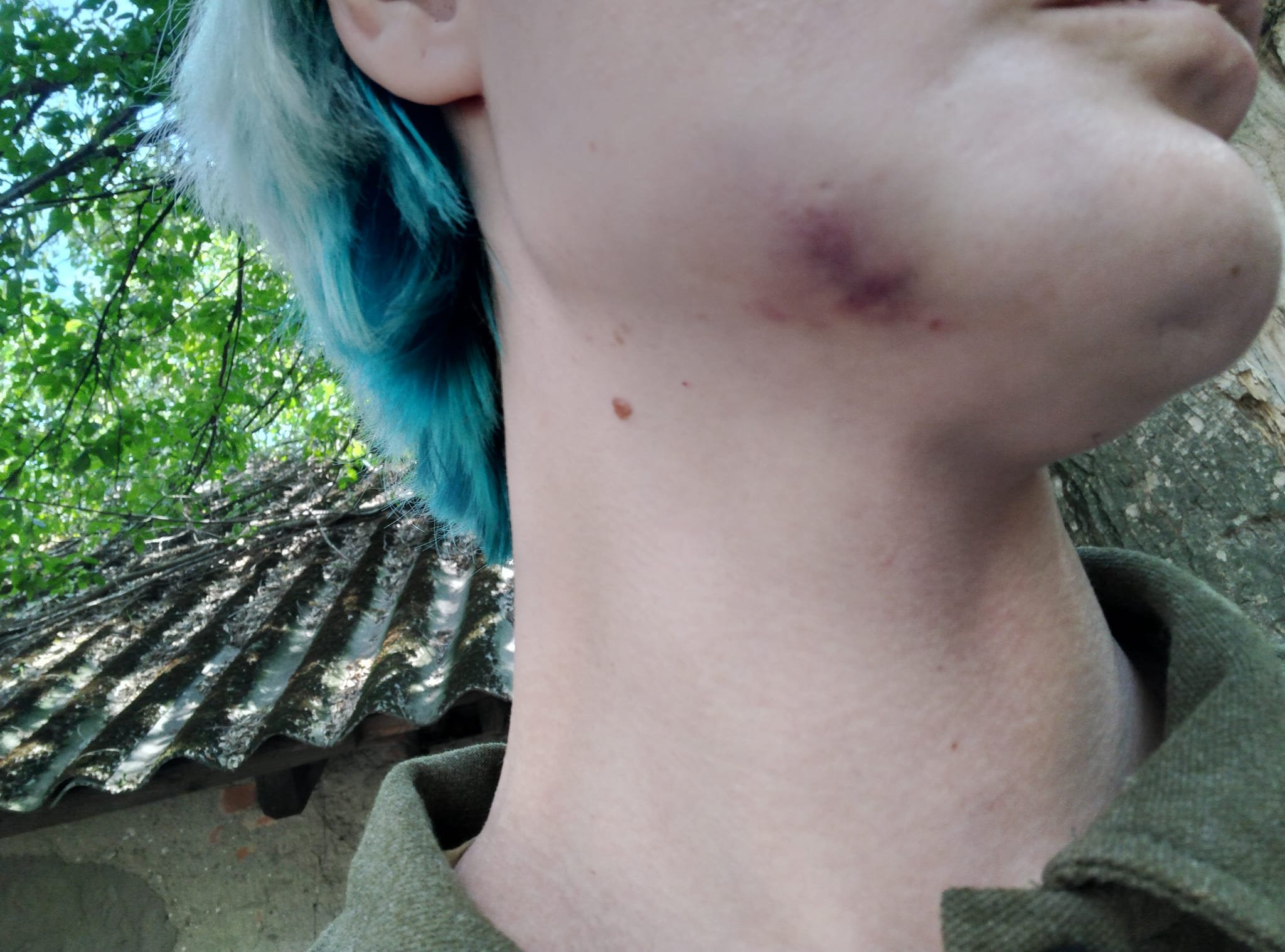 Отримані внаслідок побиття синці на щелепі Тетяни Новак