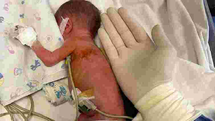 Кардіохірурги Одеси провели успішну  операцію на серці немовляті із вагою лише 900 г