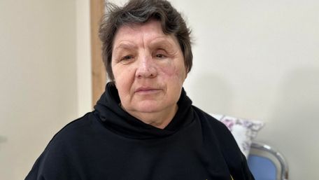 Львівські лікарі відновлюють обличчя мешканці Херсонщини, яка потрапила під обстріл