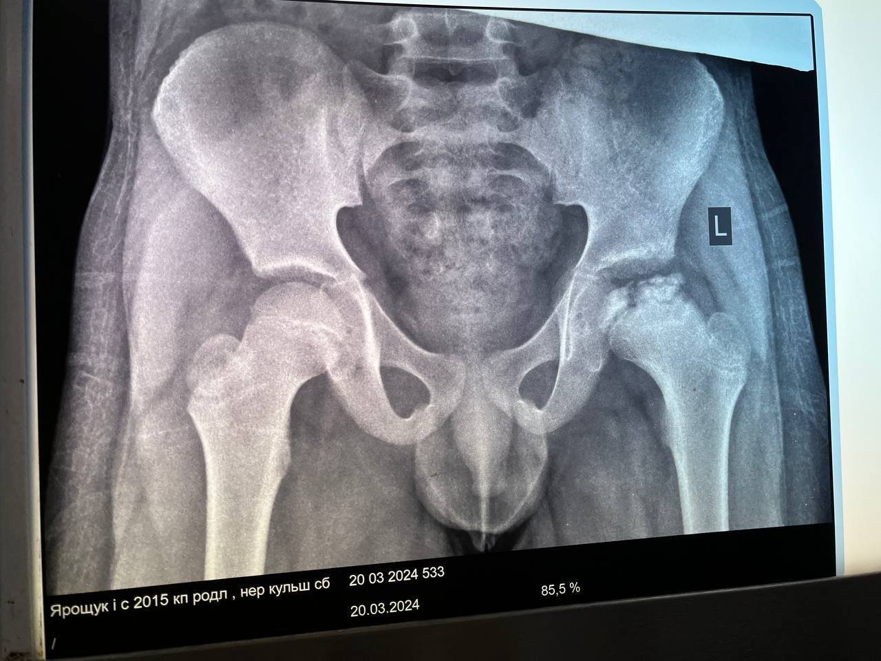 Вперше у Рівненській обласній дитячій лікарні впровадили сучасний метод лікування хвороби Пертеса (фото лікарні)