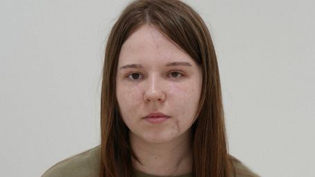 Львівські пластичні хірурги відновлюють обличчя 20-річній дівчині з Луганщини