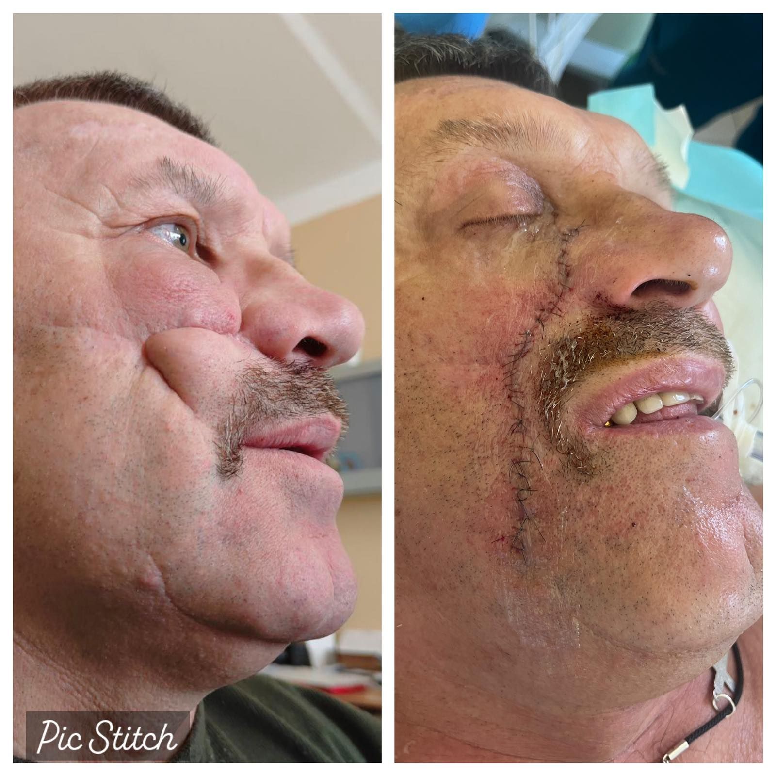 Обличчя пацієнта до і після операції xdideeieuidqrant