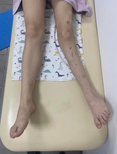 17-річна дівчинка, яка не виїжджала самостійно протягом двох років, стояла на ногах у регіональній дитячій лікарні Рівне (фотографія медичної установи)