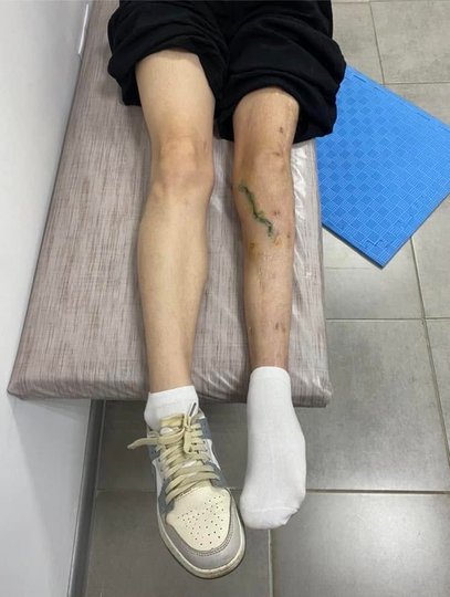 17-річна дівчинка, яка не виїжджала самостійно протягом двох років, стояла на ногах у регіональній дитячій лікарні Рівне (фотографія медичної установи)