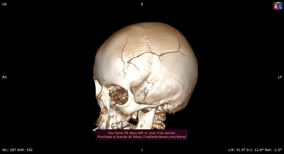 Як результат, 9-річний житель регіону Рівн зазнав серйозних травм