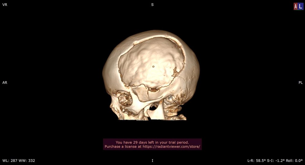 Як результат, 9-річний житель регіону Рівн зазнав серйозних травм