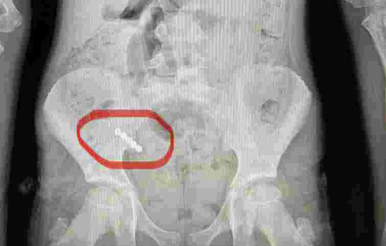 Лікарі видалили 9-річній волинянці апендикс, щоб дістати проковтнуті магніти