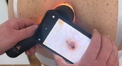 Чому доброякісні родимки перероджуються у злоякісні: як цього не допустити