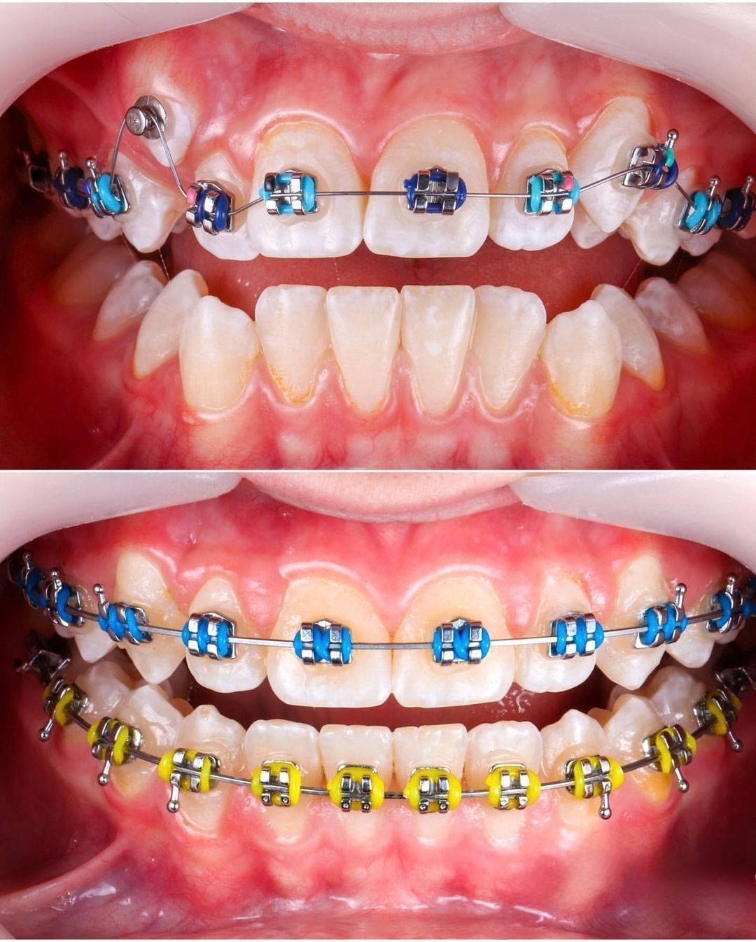 Неправильний прикус може негативно впливати на якість життя