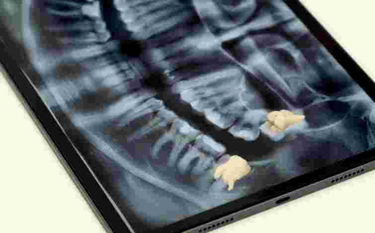 Зуби мудрості: коли обов’язково треба видаляти і де це можна зробити у Львові
