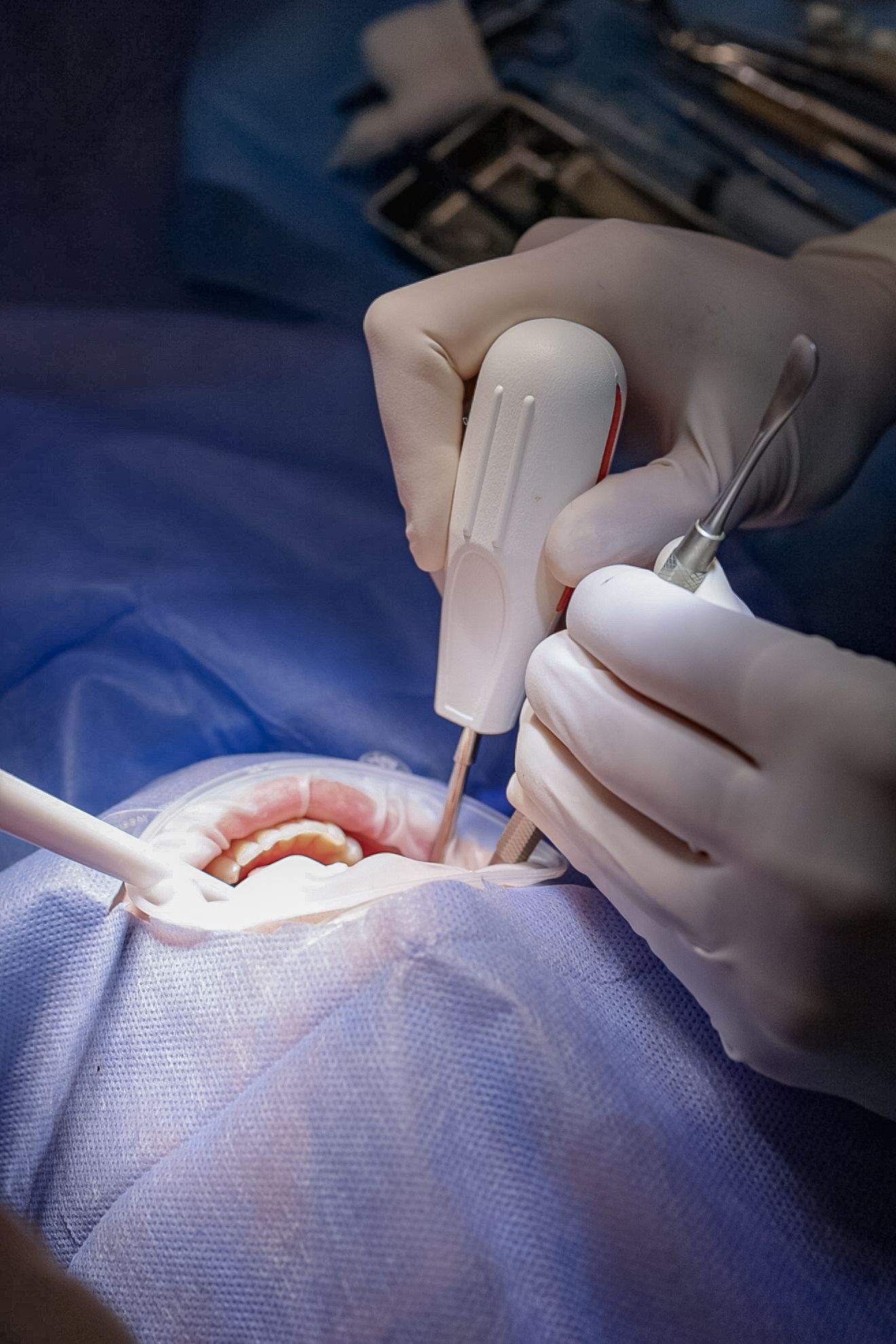 Зуби мудрості можуть доставляти багато проблем