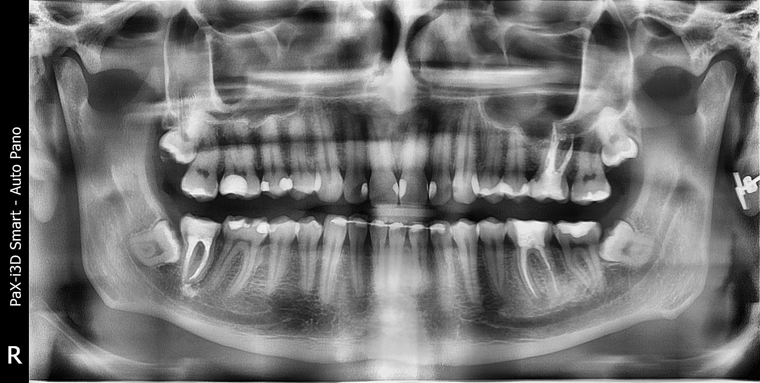 Зуби мудрості можуть зміщати зубний ряд