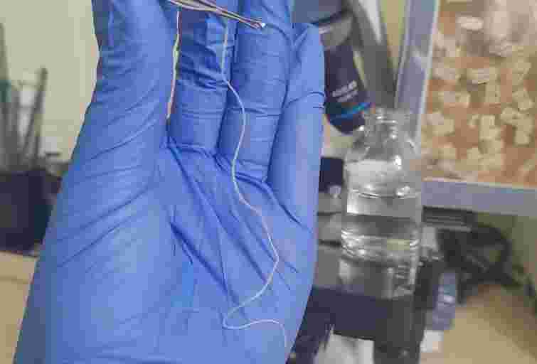 Лікарі витягнули з повіки мешканки Рівненщини 11-сантиметрового гельмінта