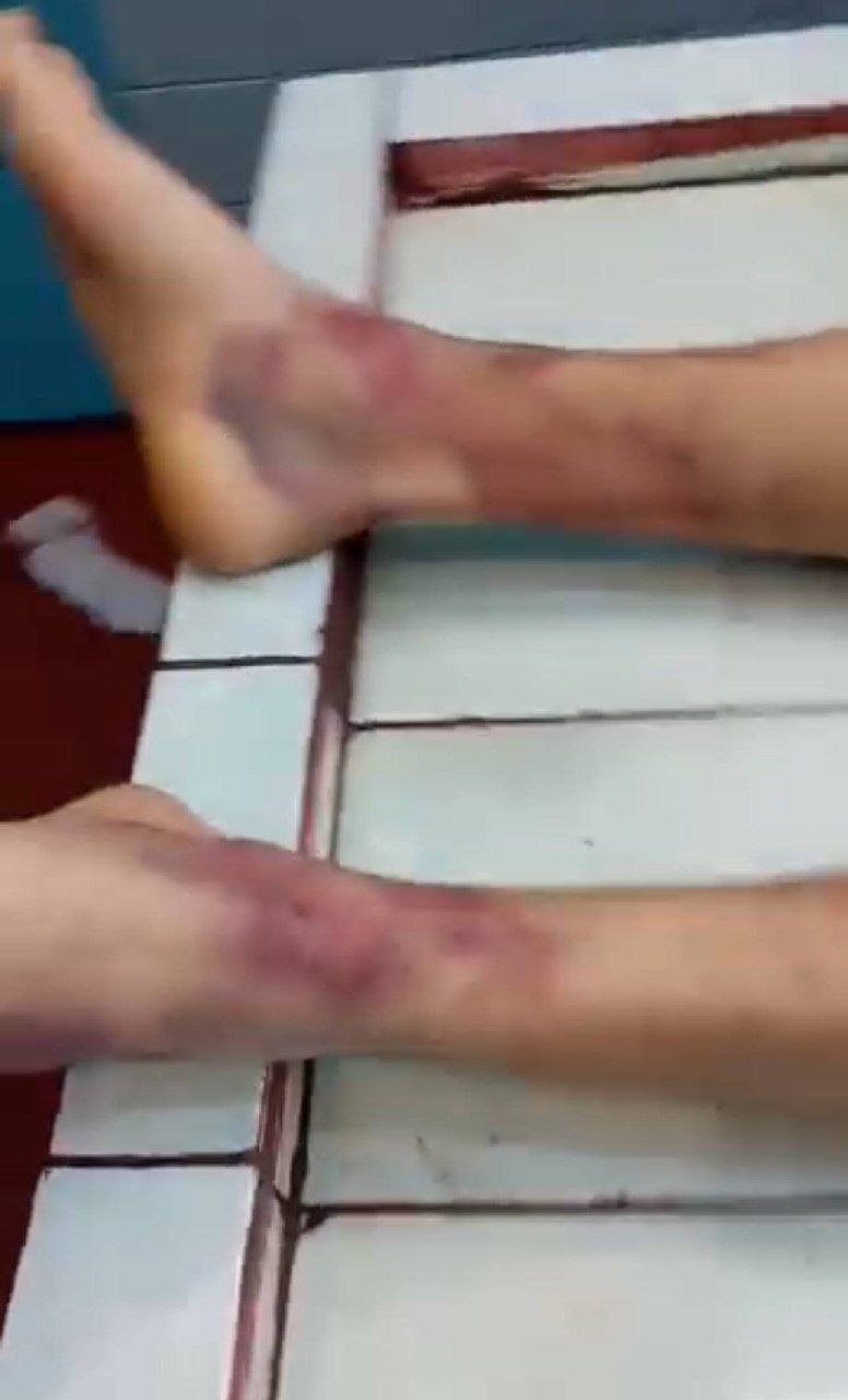 На тілі померлого після мобілізації мешканця Рівненщини виявили численні гематоми