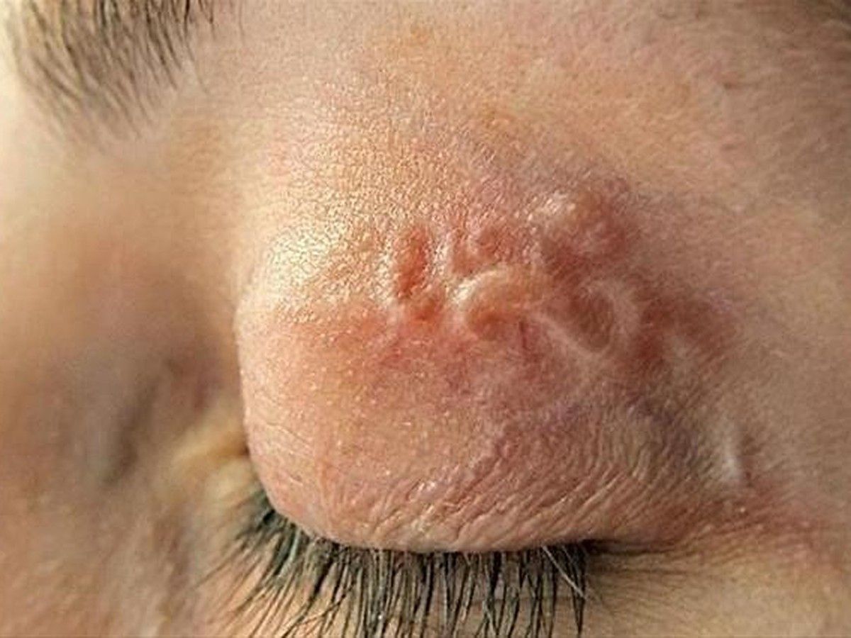 Під ключицею у 73-річної львівʼянки виявили 12-сантиметрового гельмінта