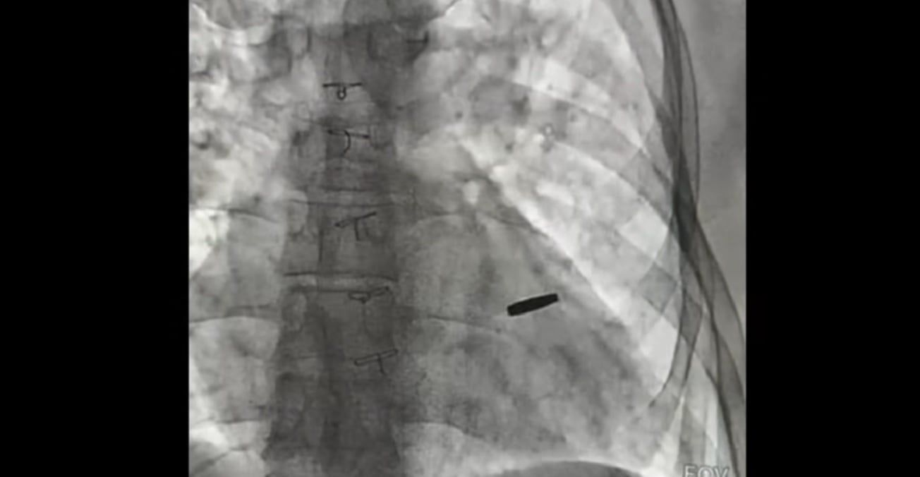 На рентгенівському знімку видно кулю у серці військового