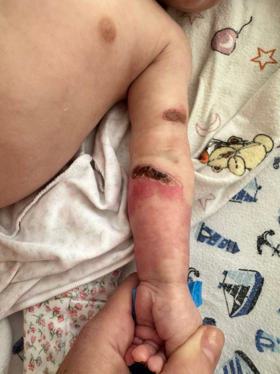 Захворювання схоже на опіки II -III cтупеня