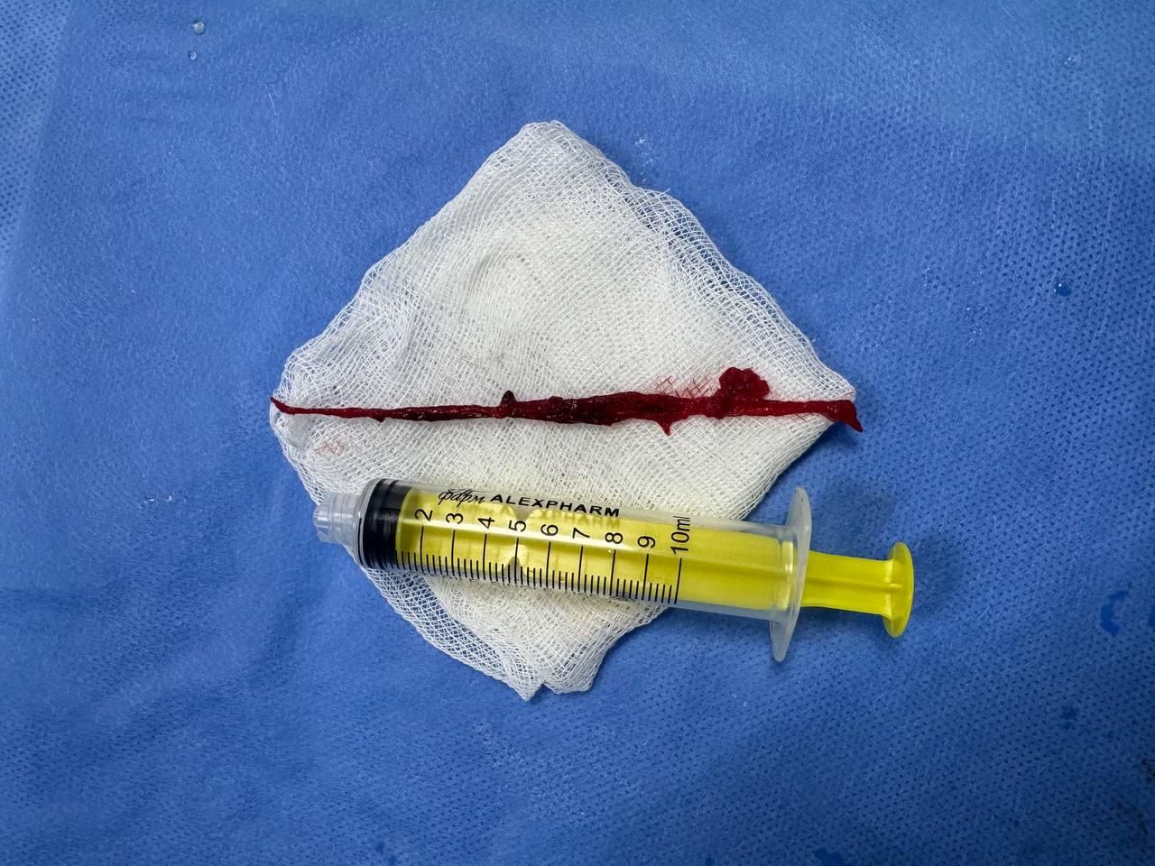 Цей тром спеціалісти дістали з легеневої артерії львів'янина