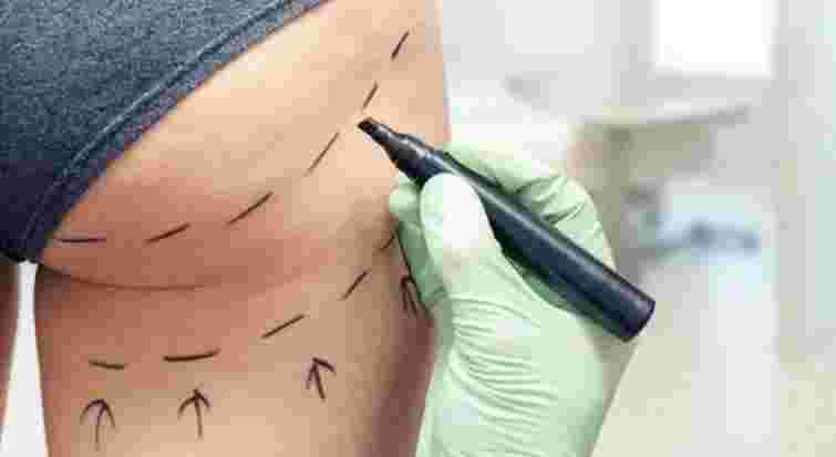 У Києві під час операції з імплантації сідниць померла 28-річна пацієнтка