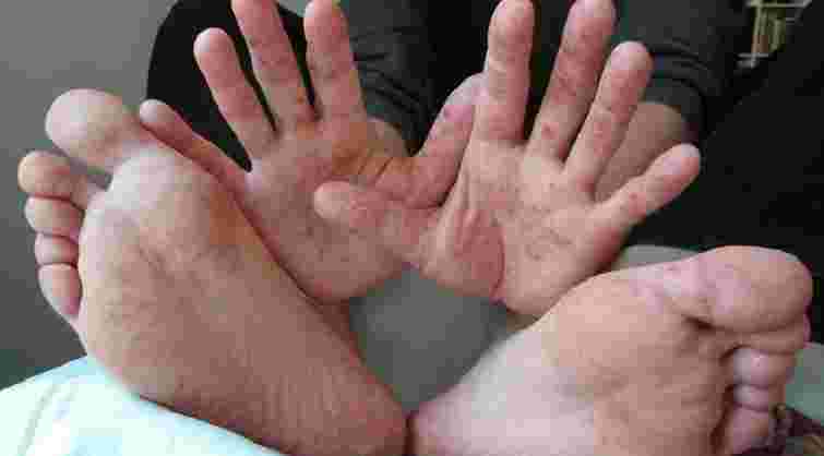 Віруси Коксакі: як вберегтися і коли викликати «швидку»
