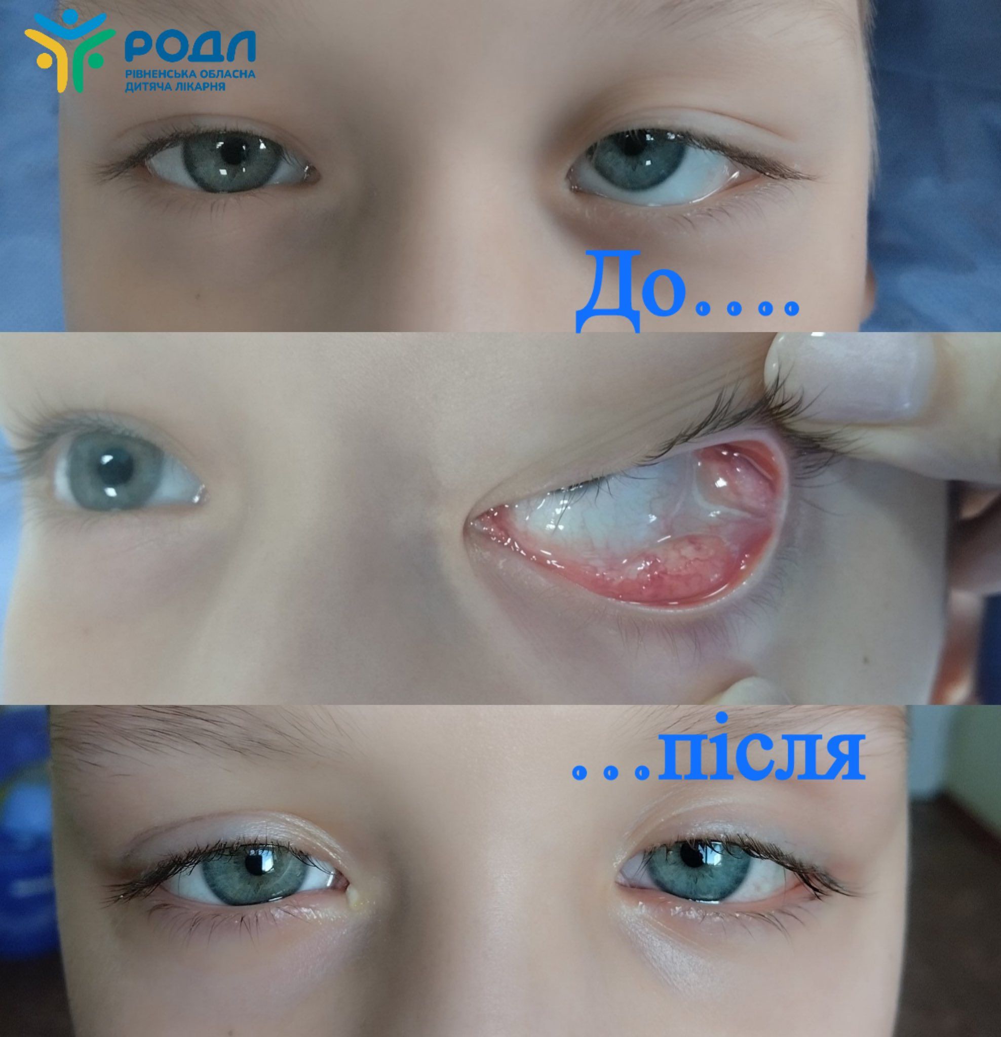 Новоутвір змістив очне яблуко з правильного положення (фото Рівненської обласної дитлікарні)