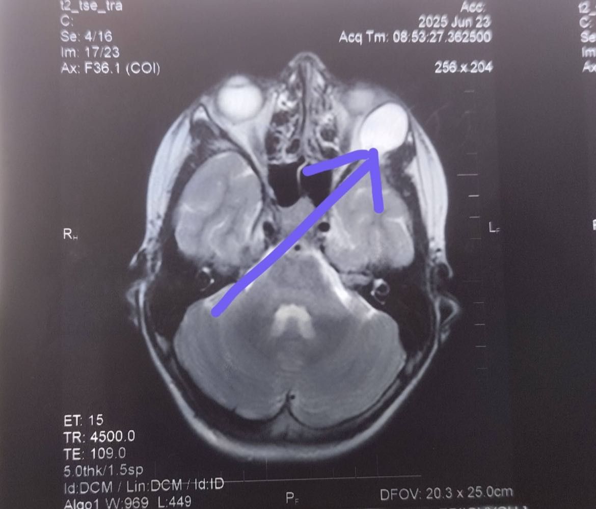 Новоутвір змістив очне яблуко з правильного положення (фото Рівненської обласної дитлікарні)